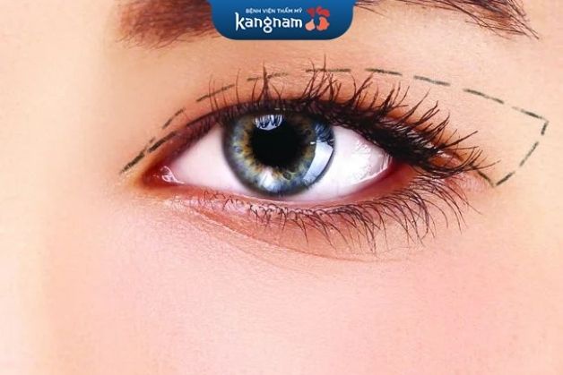 Cách chăm sóc sau khi cắt mí Plasma plus