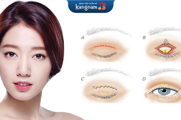 Cắt chỉnh mí Plasma Plus không đau, không xâm lấn