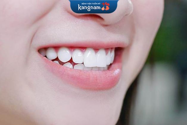 Răng sứ kim loại giá bao nhiêu tùy vào chất lượng sứ