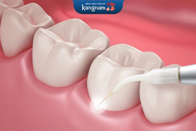 Chữa cười hở lợi bằng laser khá an toàn