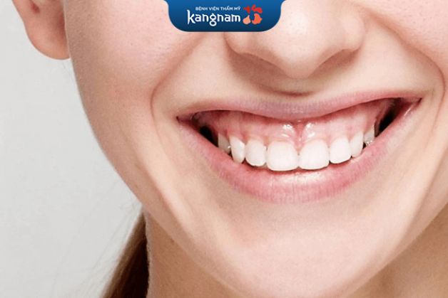 Điều trị cười hở lợi hiệu quả bằng phương pháp cắt bớt lợi thừa