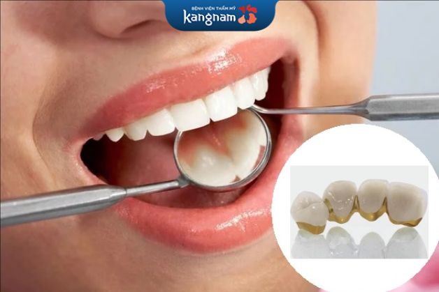 Có nên bọc răng sứ titan không?