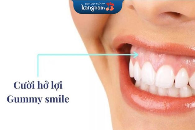 Cười hở lợi không có tính thẩm mỹ cao