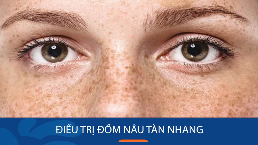 Điều trị đốm nâu tàn nhang tận gốc, xóa sạch đến 95%