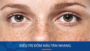 Điều trị đốm nâu tàn nhang tận gốc, xóa sạch đến 95%