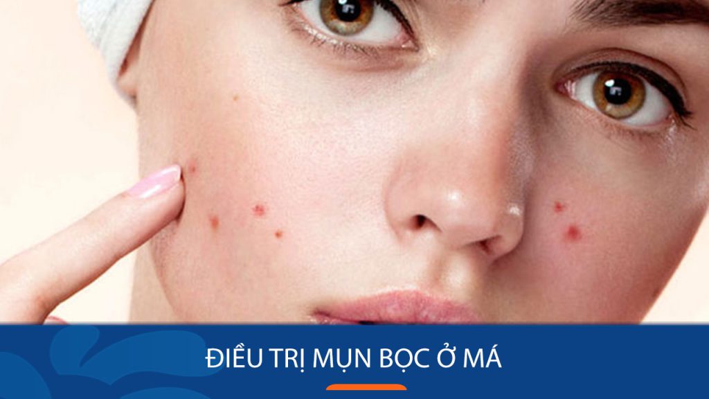 Cách trị mụn bọc ở má hiệu quả NHANH NHẤT tại nhà – benhvienthammykangnam