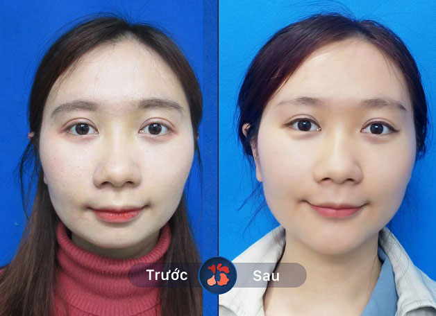 Khách hàng gặp khuyết điểm cằm thụt vào trong cũng được khắc phục hiệu quả tại Kangnam