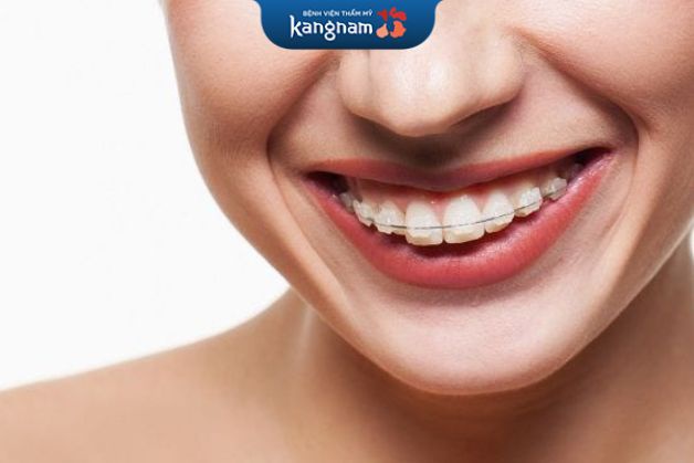 Niềng răng mắc cài sứ bao nhiêu tiền