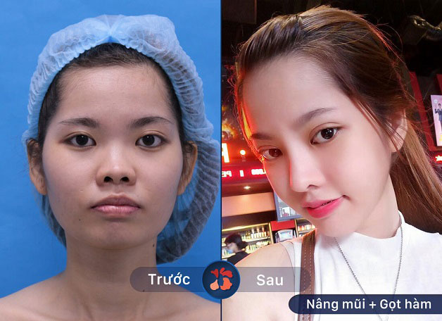 Gọt hàm có giảm tuổi thọ không?