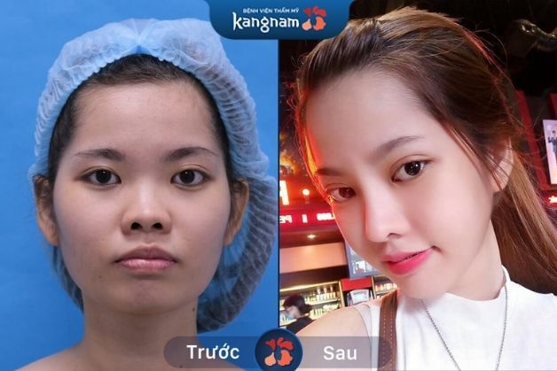 Diện mạo tươi tắn và trẻ trung hơn sau khi gọt hàm