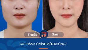 Gọt hàm có vĩnh viễn không? Bác sĩ phẫu thuật Kangnam giải đáp