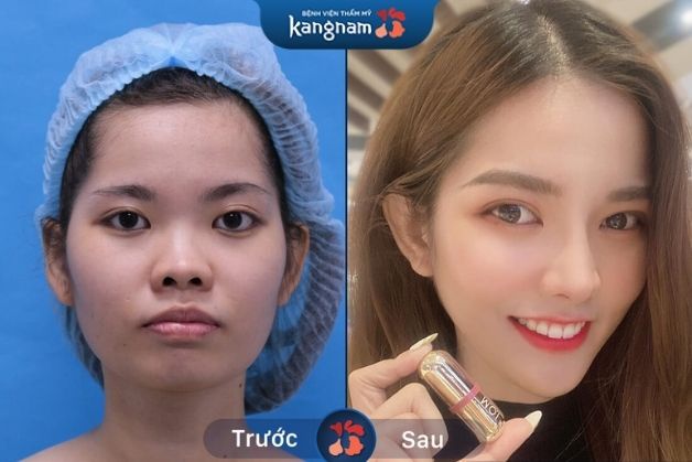 Cải thiện hàm thô, giúp gương mặt trở nên V-line quyến rũ