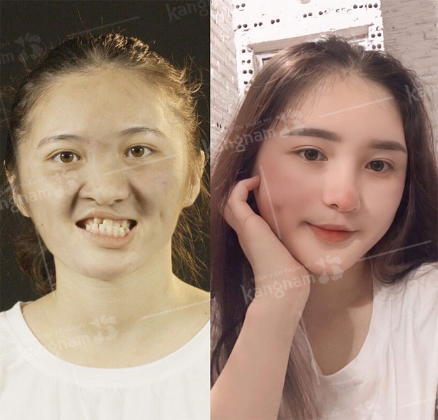 Khách hàng thay đổi hoàn toàn sau khi phẫu thuật hở hàm ếch