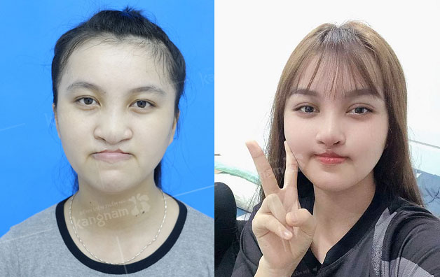 Trước và sau khi phẫu thuật hở hàm ếch hoàn toàn khác biệt