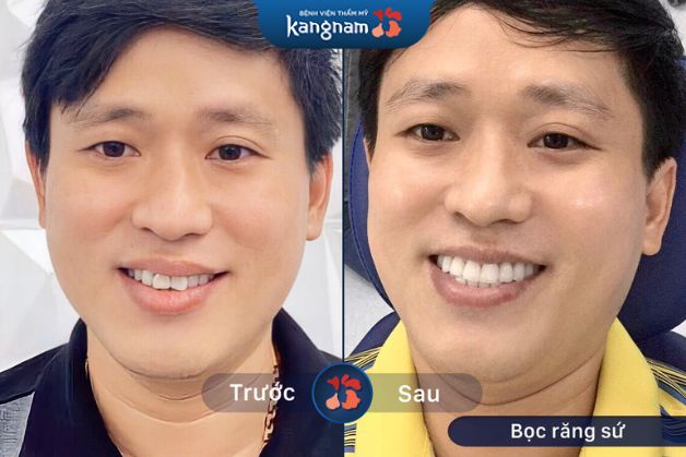 Khách hàng bọc răng sứ, cải thiện nụ cười đẹp nhanh chóng