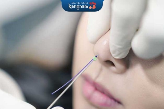 Mũi sau khi cấy chỉ ổn định nhanh