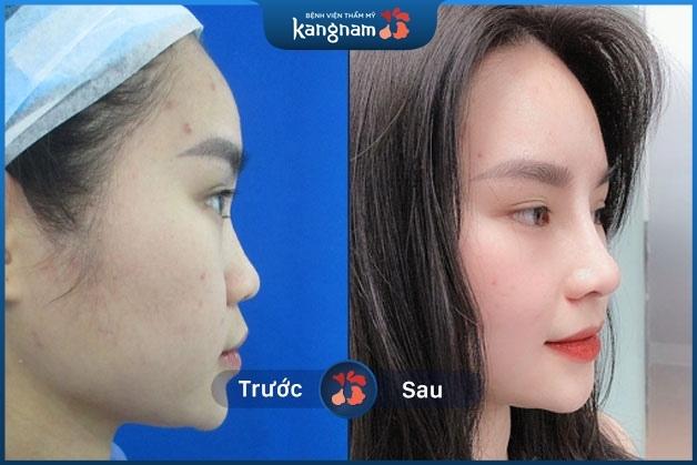 Nâng mũi bọc sụn vành tai ở phần đầu tạo dáng tự nhiên