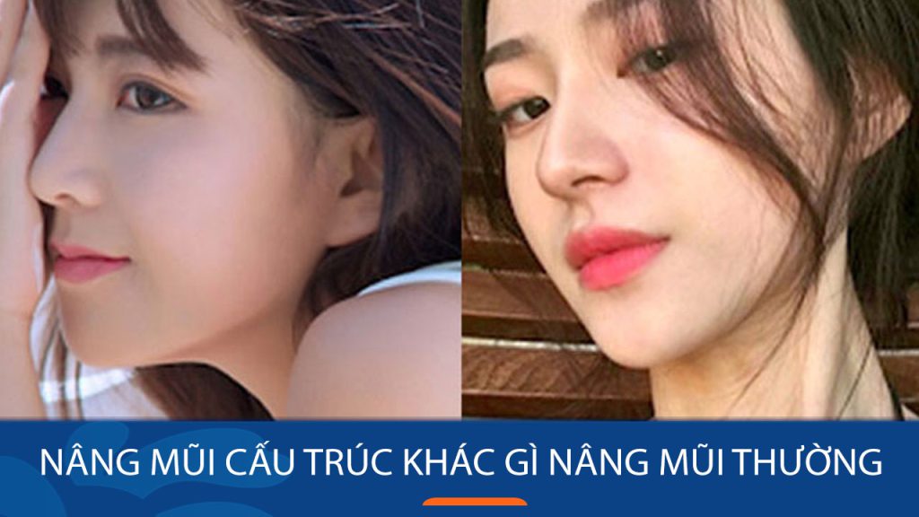 Nâng mũi cấu trúc khác gì nâng mũi thường? So sánh chi tiết dễ hiểu