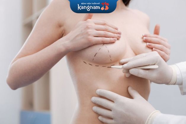 Nâng ngực qua đường chân ngực chỉ cần 5-7 ngày nghỉ dưỡng