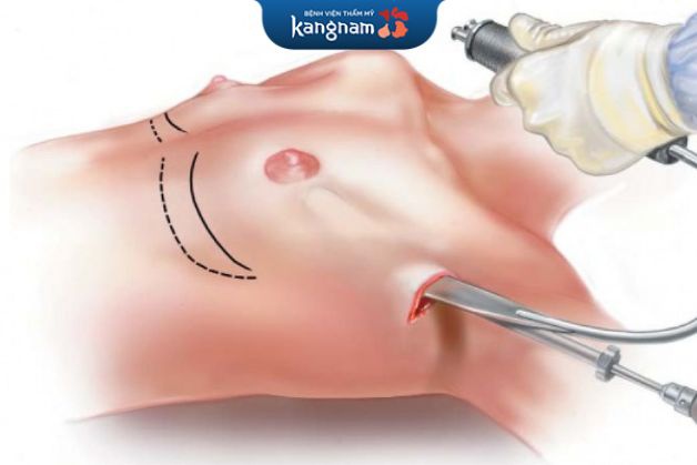 Nâng ngực qua đường nách cần từ 2 - 4 tuần nghỉ dưỡng