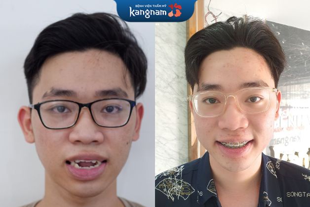 Chỉ sau 6 tháng, răng chạy đều và ổn định hơn