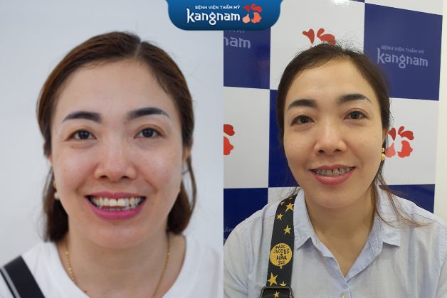 Răng đều đẹp giúp gương mặt trở nên tươi tắn, trẻ trung hơn