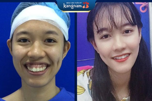 Thay đổi diện mạo ngoạn mục nhờ niềng răng thẩm mỹ Kangnam
