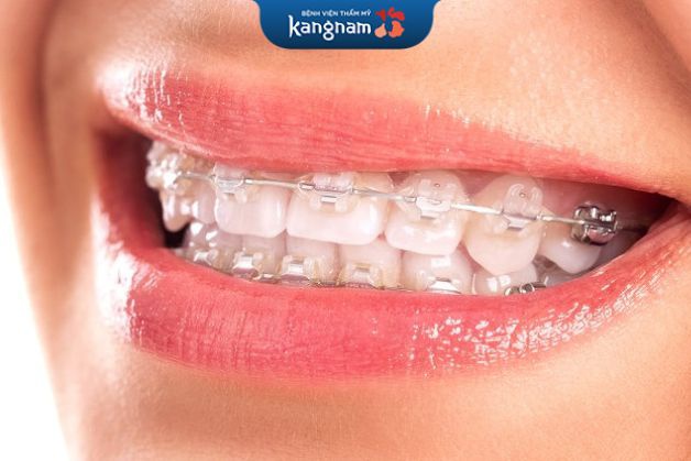 Niềng răng mắc cài sứ có giá từ 42-55 triệu đồng