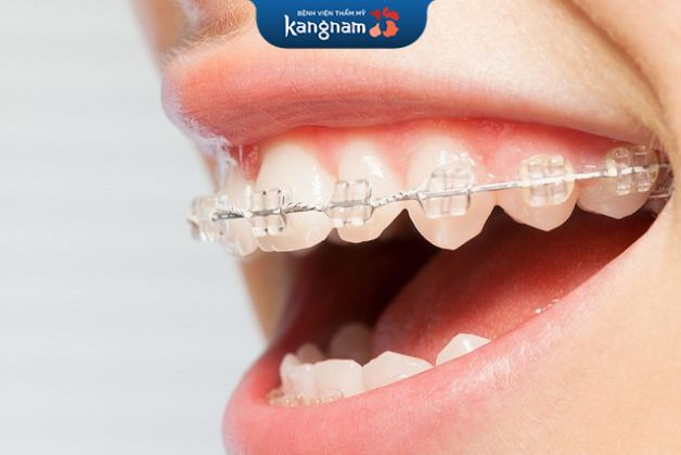 Mắc cài sứ không những mang đến độ hiệu quả cao tương tự như mắc cài kim loại