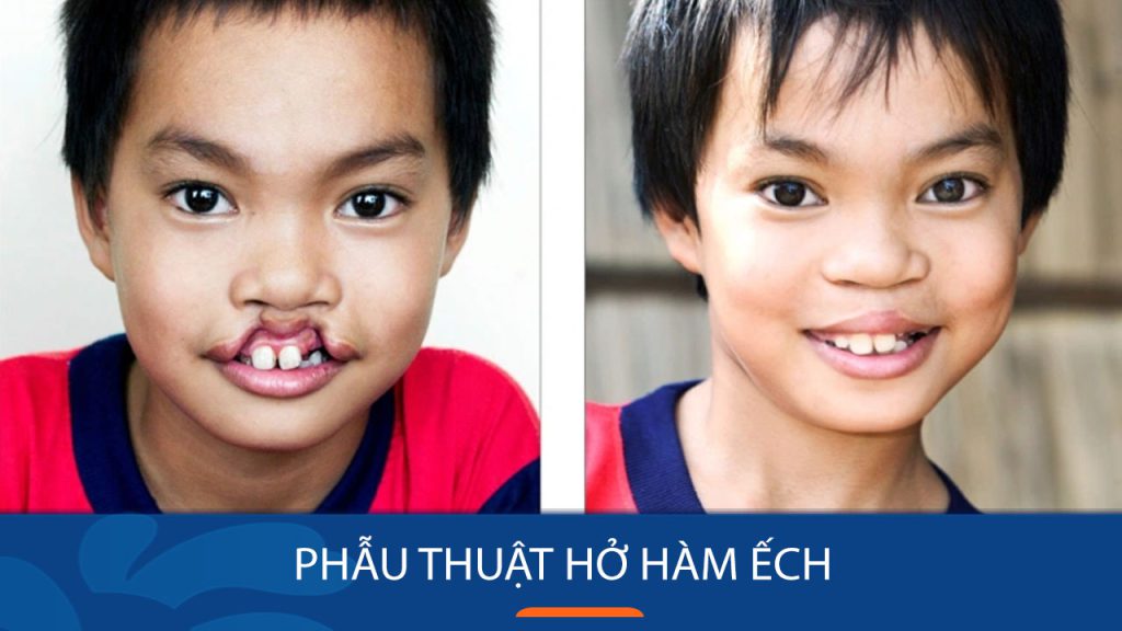 Phẫu thuật hở hàm ếch thành công cho bé – Bệnh viện thẩm mỹ kangnam