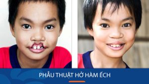 Phẫu thuật hở hàm ếch thành công cho bé – Bệnh viện thẩm mỹ kangnam