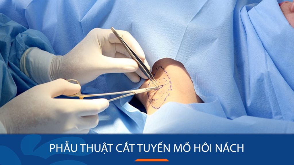 Phẫu thuật cắt tuyến mồ hôi nách ở đâu hiệu quả, không tái lại?