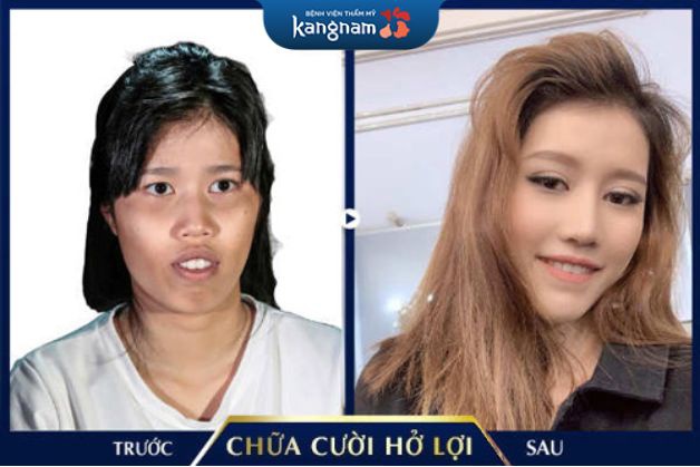 Chữa cười hở lợi thành công cho khách hàng tình trạng nặng