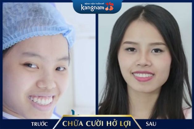 ĐIều trị cười hở lợi giúp răng cân đối hơn với gương mặt