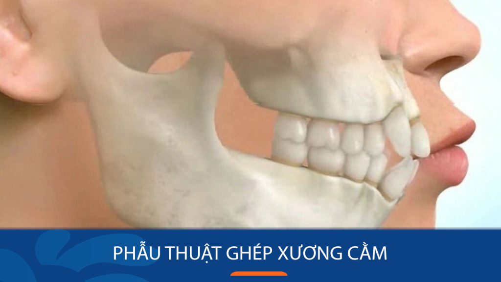 Phẫu thuật ghép xương cằm có đau không? Cần lưu ý những gì