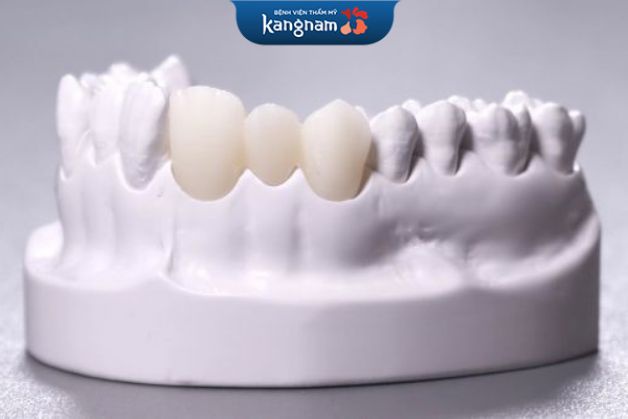 Răng sứ Cercon có tính thẩm mỹ cao