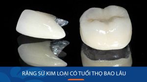 Răng sứ kim loại có tuổi thọ bao lâu? Bí quyết giúp tăng tuổi thọ