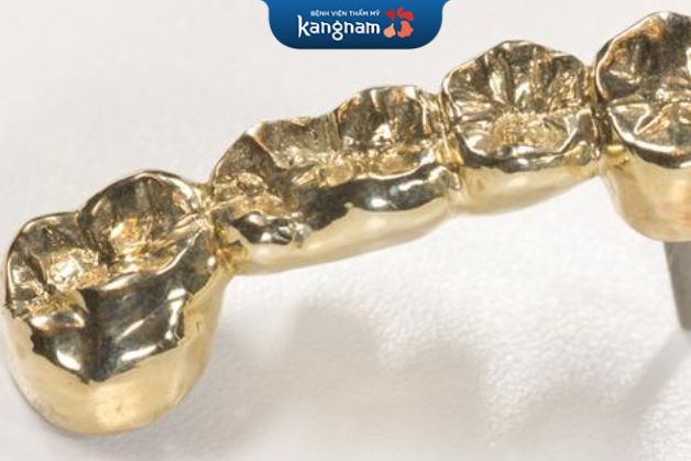 Răng sứ kim loại có tuổi thọ bao lâu