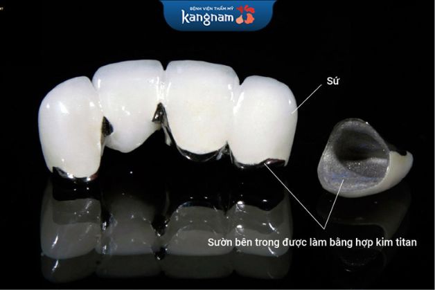 Răng sứ titan có nhiều mức giá