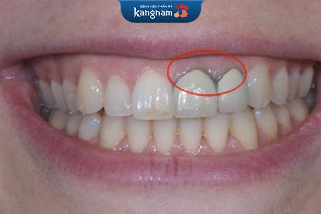 Răng sứ titan có bị đen không?