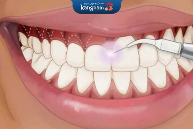 dùng điện loại bỏ lợi thường được áp dụng tại khu vực không có máu