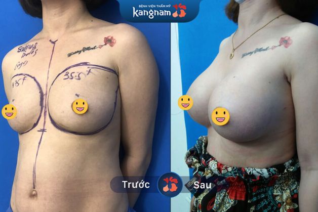 Không lộ sẹo phẫu thuật, ngực mềm mại như thật