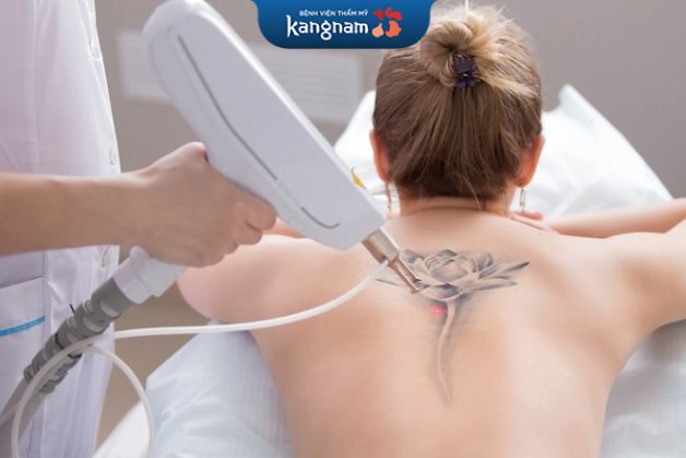 Xóa xăm bằng laser là phương pháp phổ biến