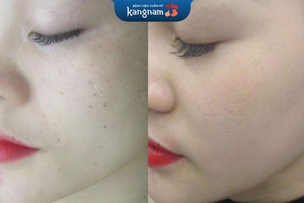 Tàn nhang li ti xóa sạch đến 95%