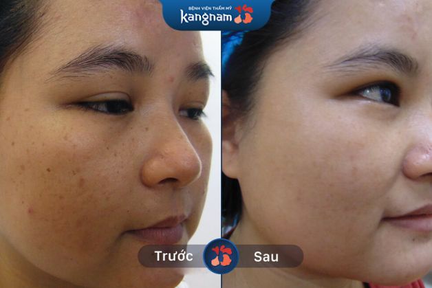 Cải thiện tàn nhang sau buổi điều trị đầu tiên