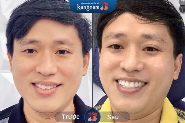 Hàm răng trắng sáng mà đều đẹp hơn