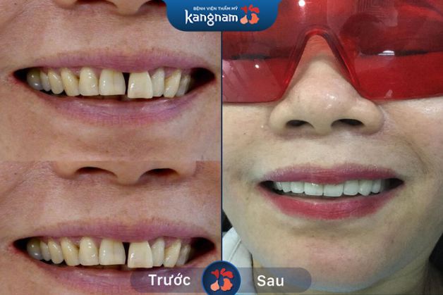 Răng bọc sứ duy trì lâu dài cho khách hàng