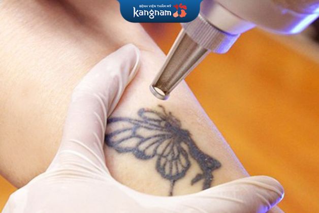 Xóa hình xăm không sẹo