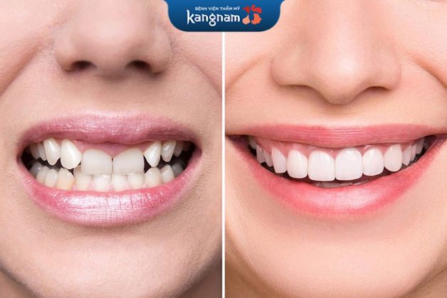 Răng sứ cercon có tốt không