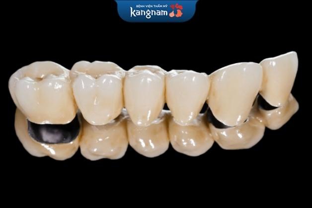 Răng sứ titan được khá nhiều khách hàng lựa chọn